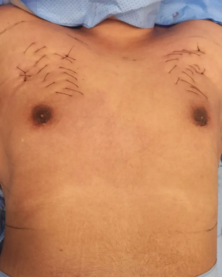 Liposuction in Dubai