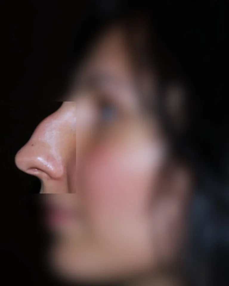 Rhinoplasty in Dubai