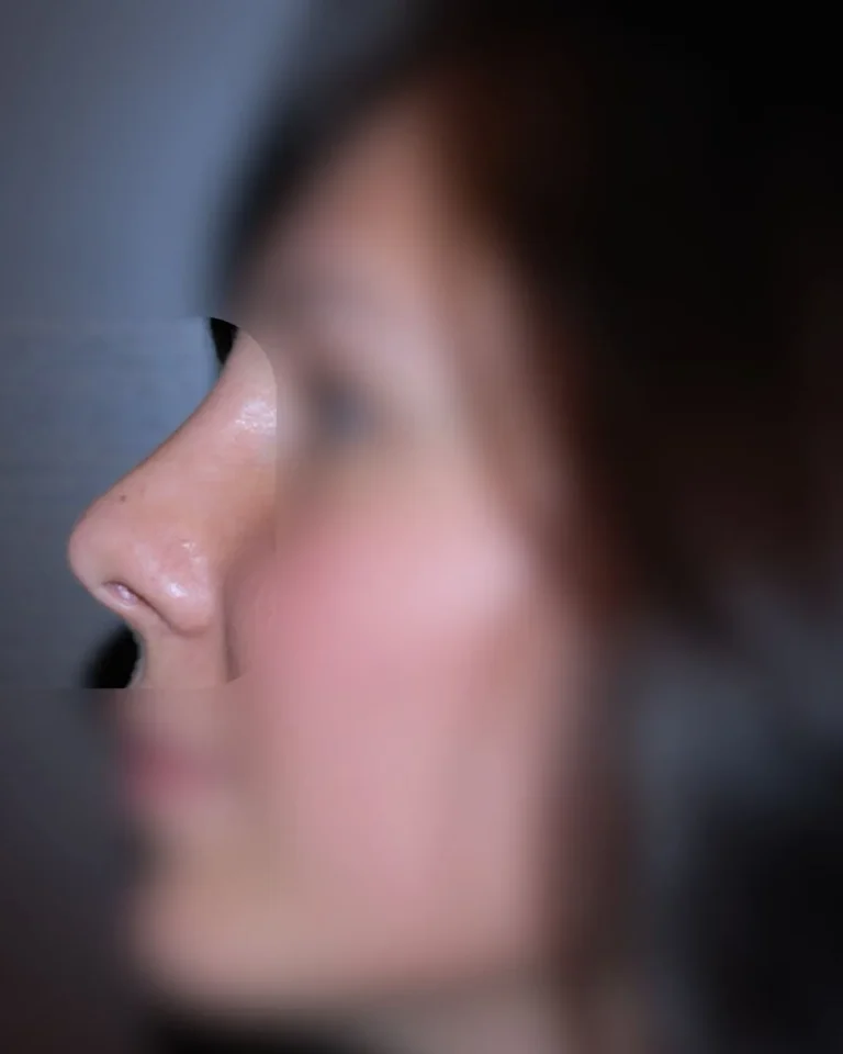 Rhinoplasty in Dubai