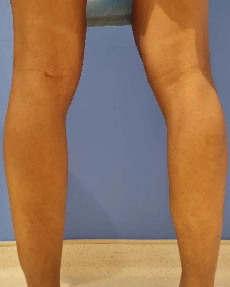 Calf Augmentation in Dubai