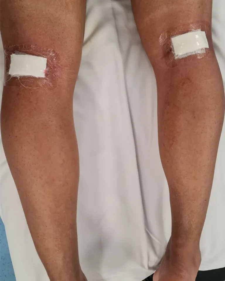 Calf Augmentation in Dubai