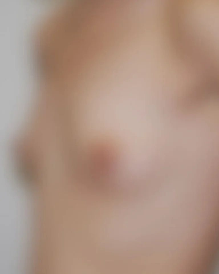 Breast Augmentation in Dubai