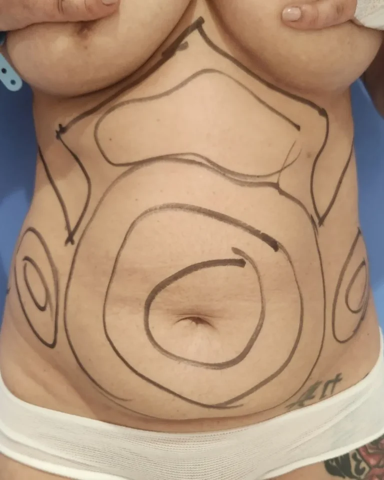 Liposuction in Dubai