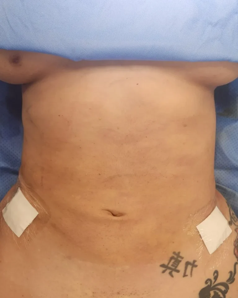 Liposuction 18 Liposuction in Dubai