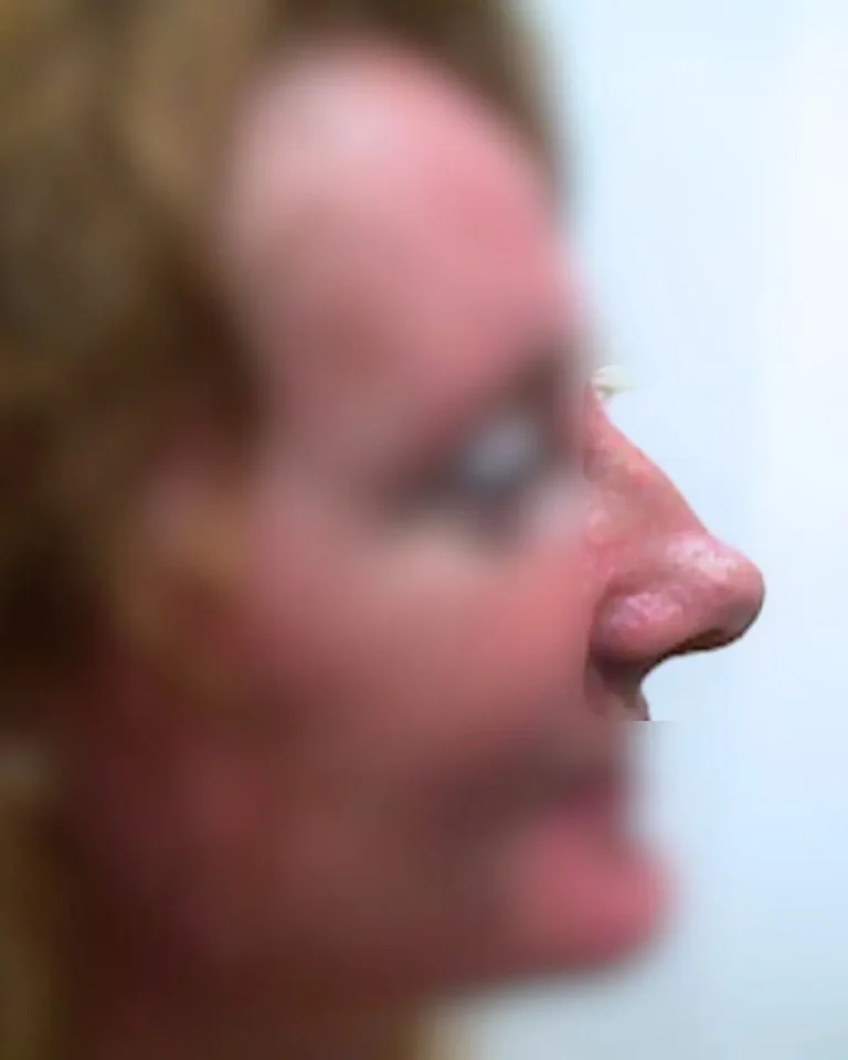 Rhinoplasty in Dubai