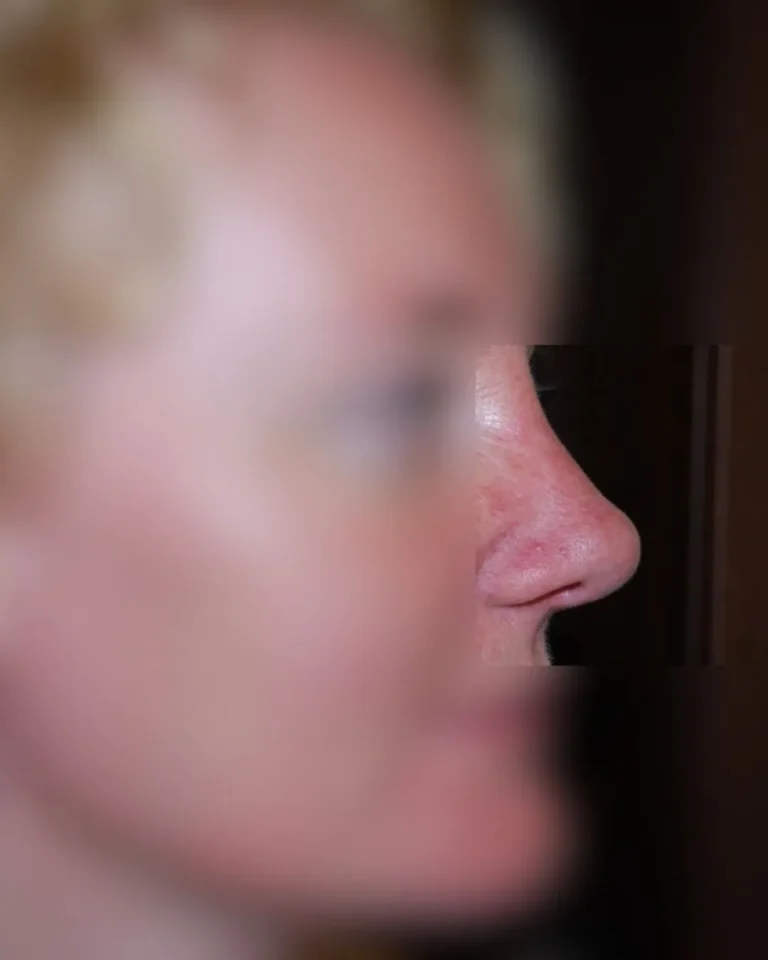 Rhinoplasty in Dubai