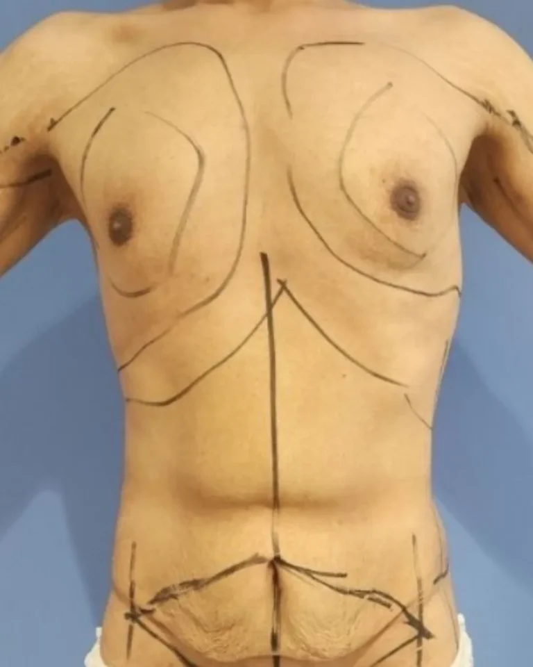 Liposuction in Dubai