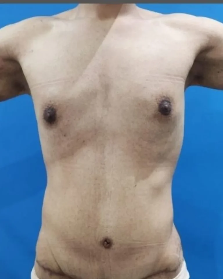 Liposuction 20 Liposuction in Dubai