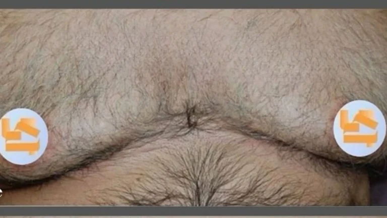 Gynecomastia in Dubai