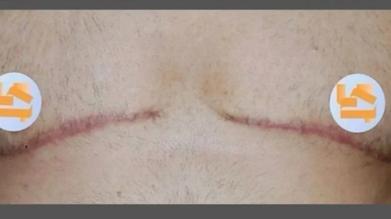 Gynecomastia 24 Gynecomastia in Dubai