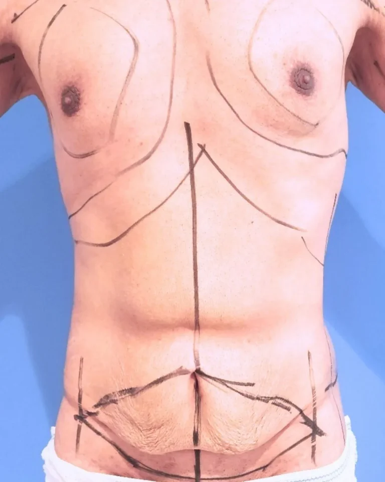 Liposuction in Dubai