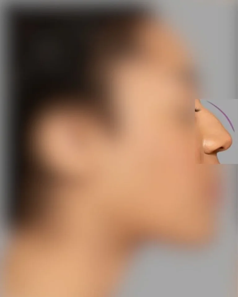 Rhinoplasty in Dubai