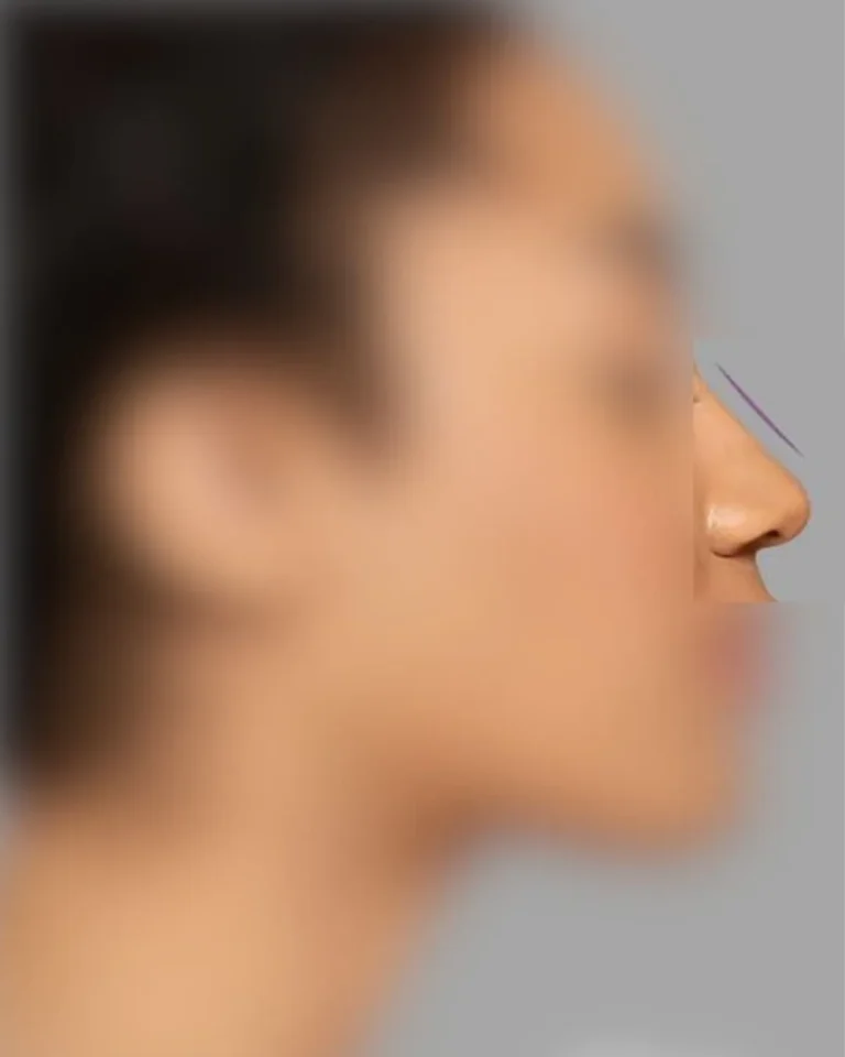 Rhinoplasty in Dubai
