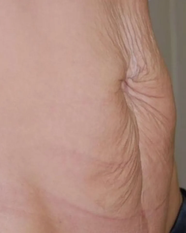 Tummy tuck