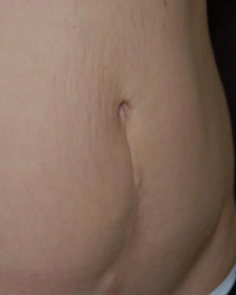 Tummy tuck 13 Tummy tuck