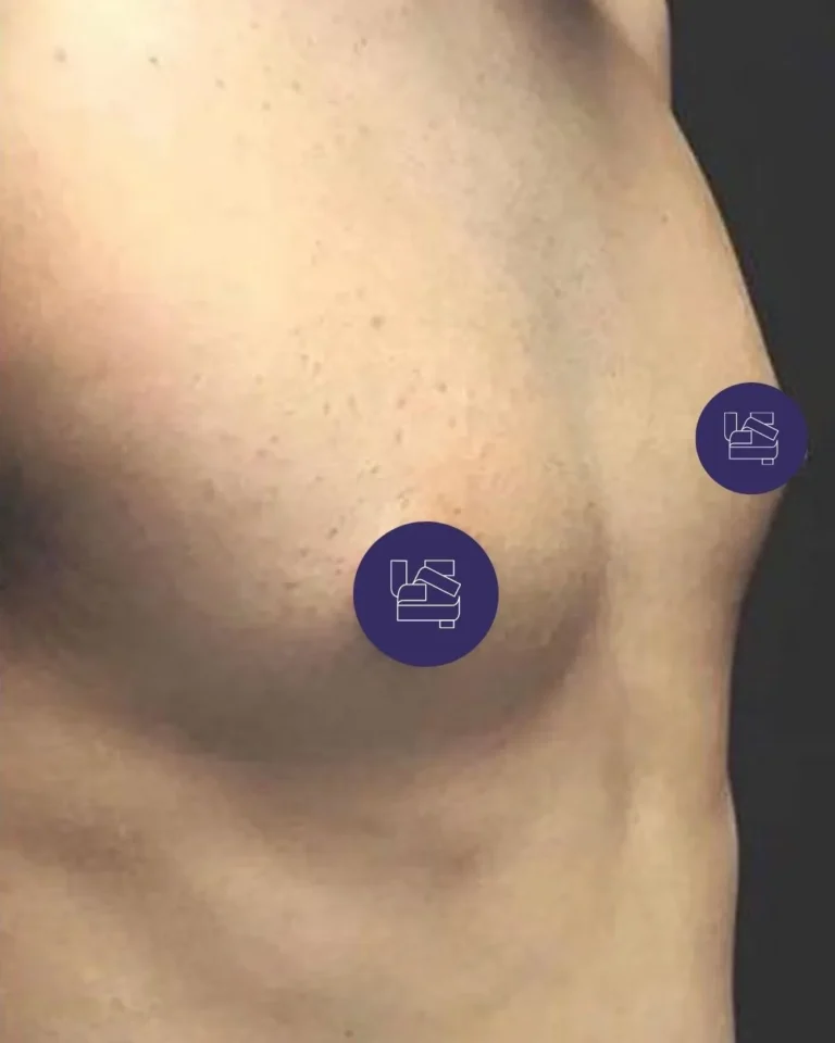 Gynecomastia in Dubai