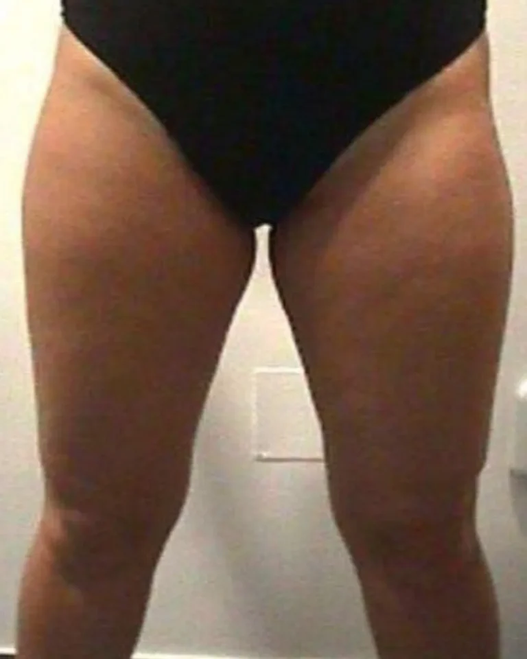 Liposuction in Dubai