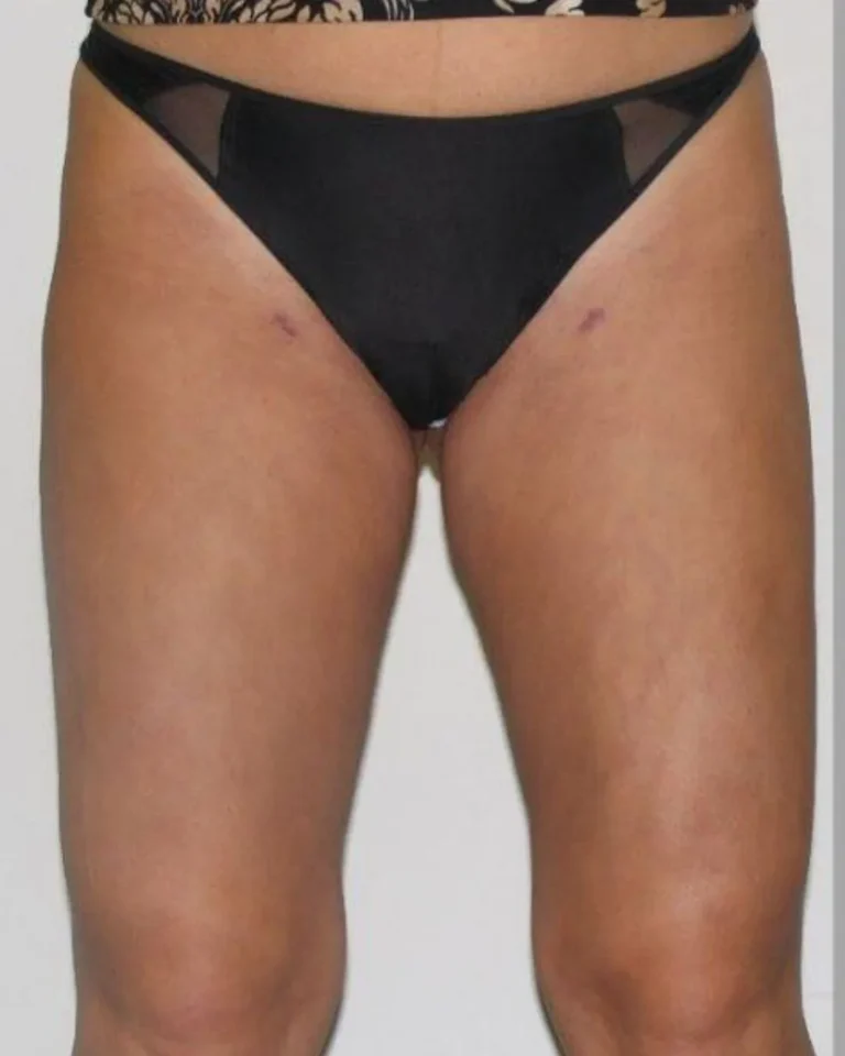 Liposuction in Dubai