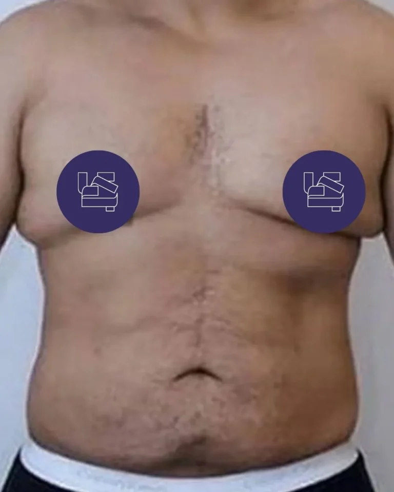 Liposuction in Dubai
