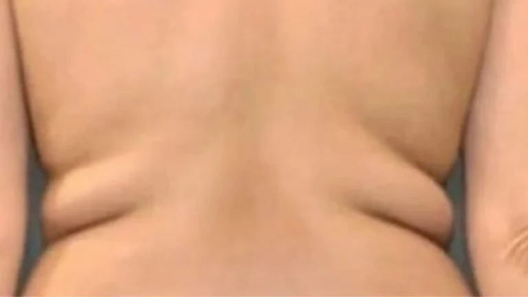 Liposuction in Dubai