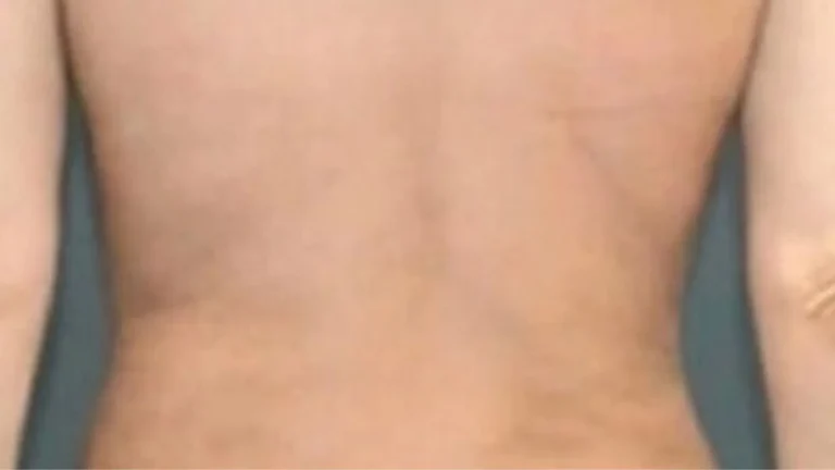 Liposuction in Dubai