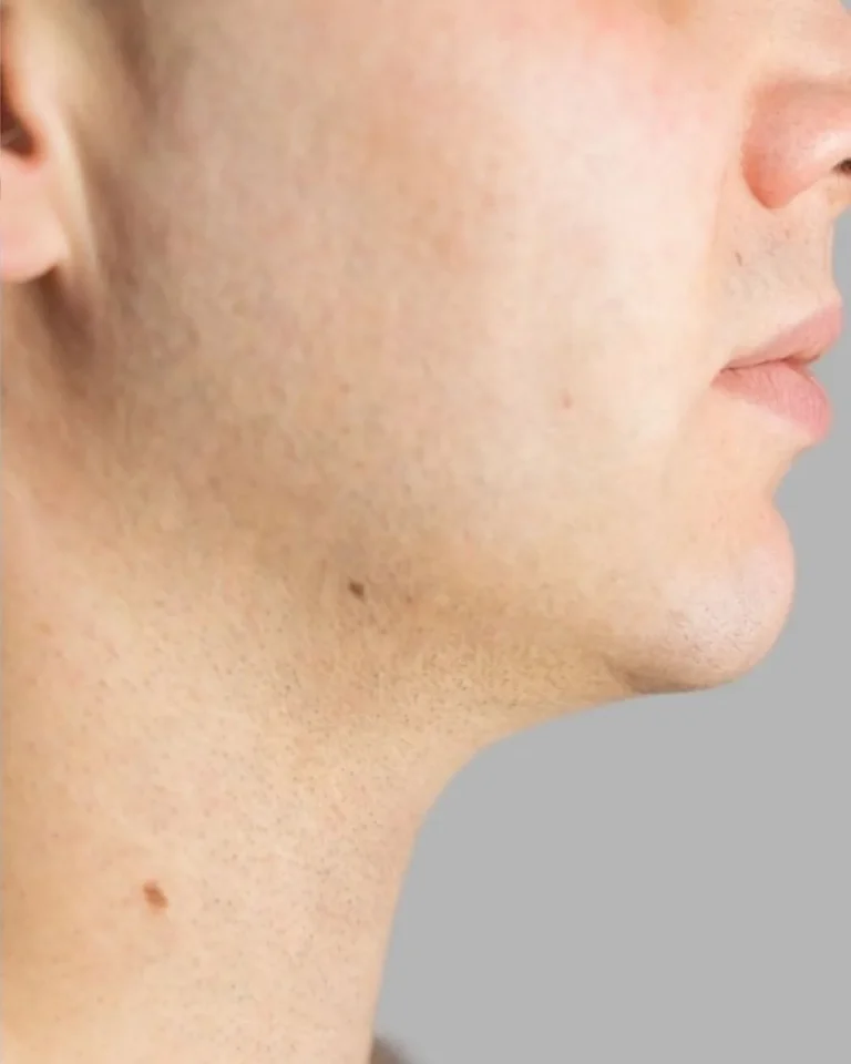 Chin Surgery