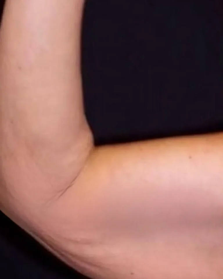 Liposuction in Dubai