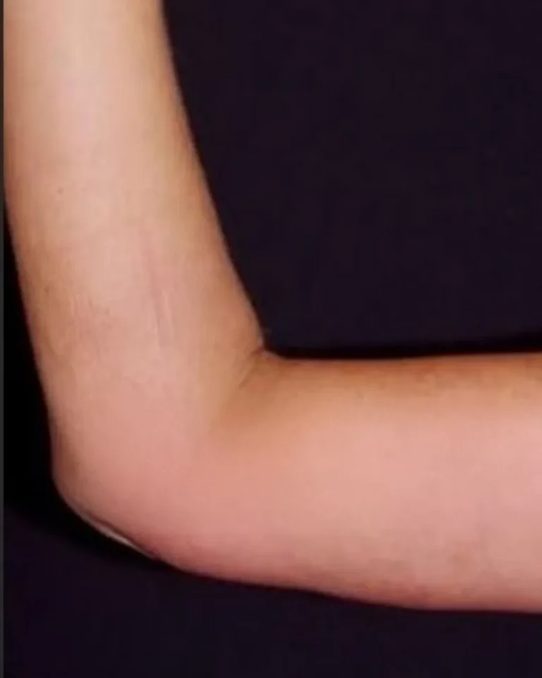 Liposuction in Dubai