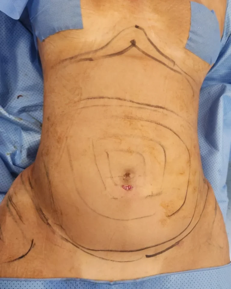 Liposuction in Dubai