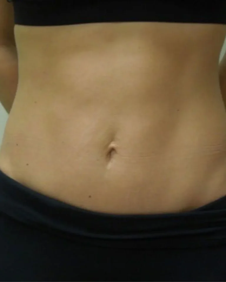 Liposuction in Dubai