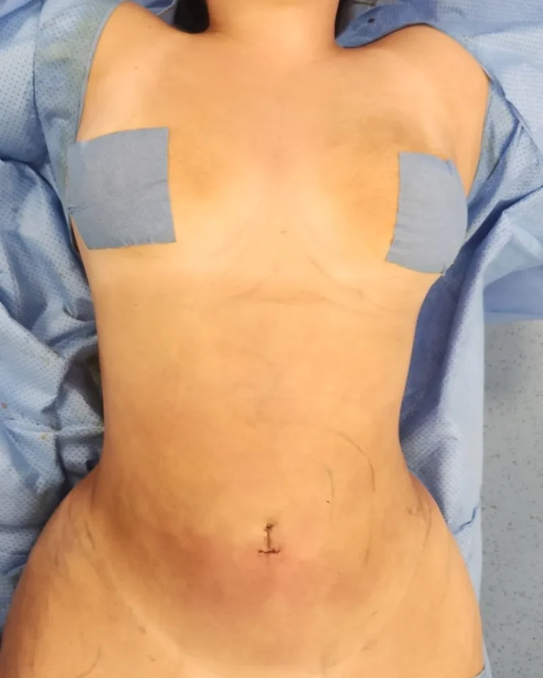 Liposuction in Dubai