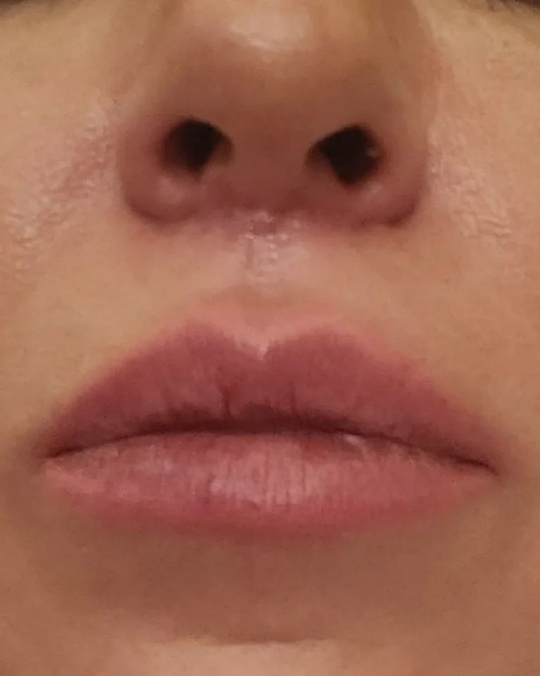 Lip Filler in Dubai