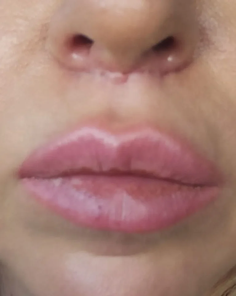 Lip Filler in Dubai