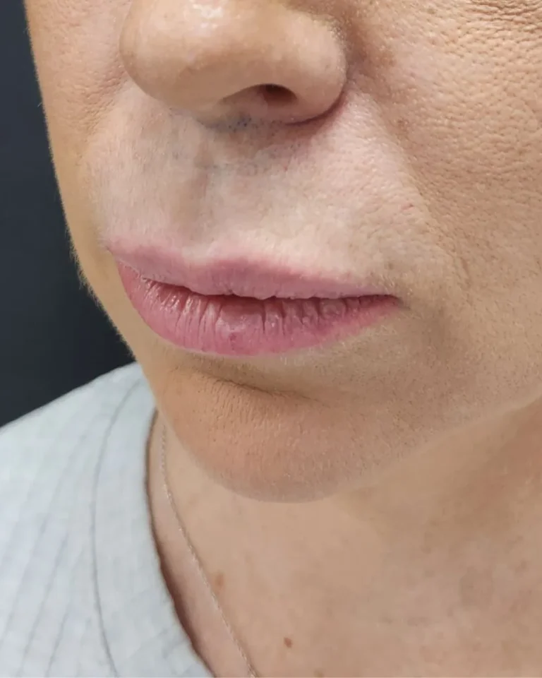 Lip Filler in Dubai