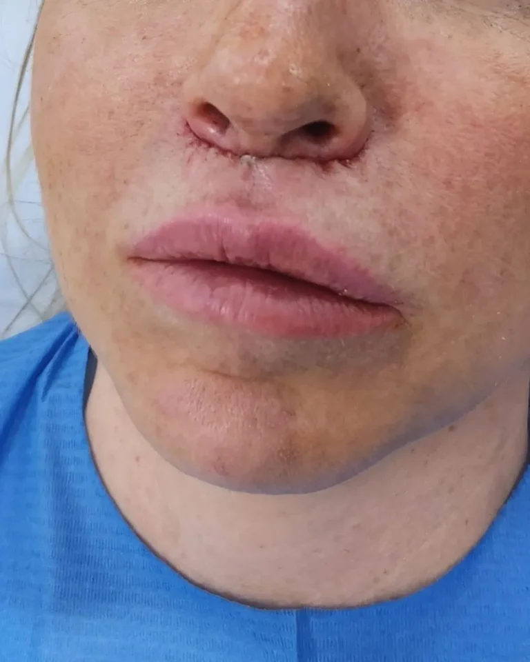 Lip Filler in Dubai