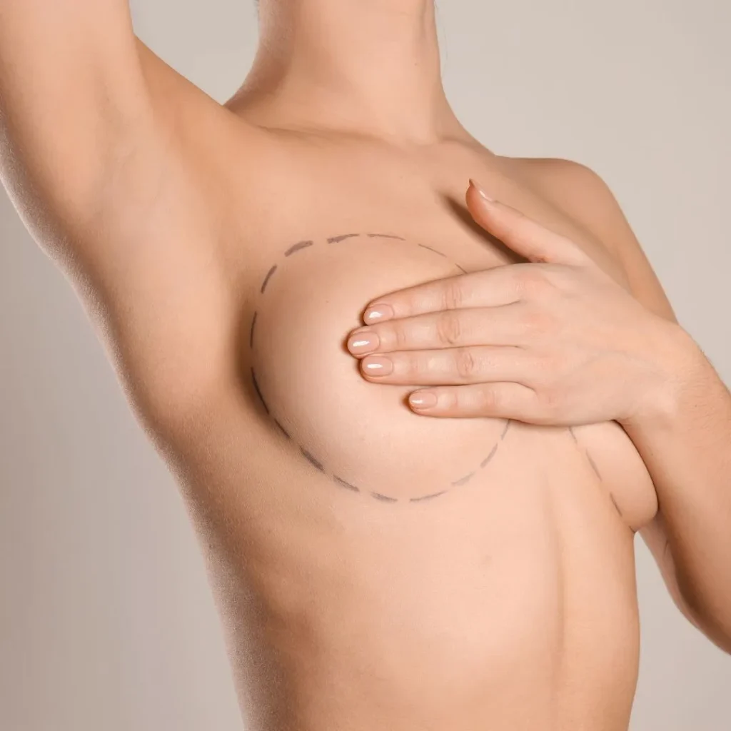 Breast lift 1 breast lift Dubai