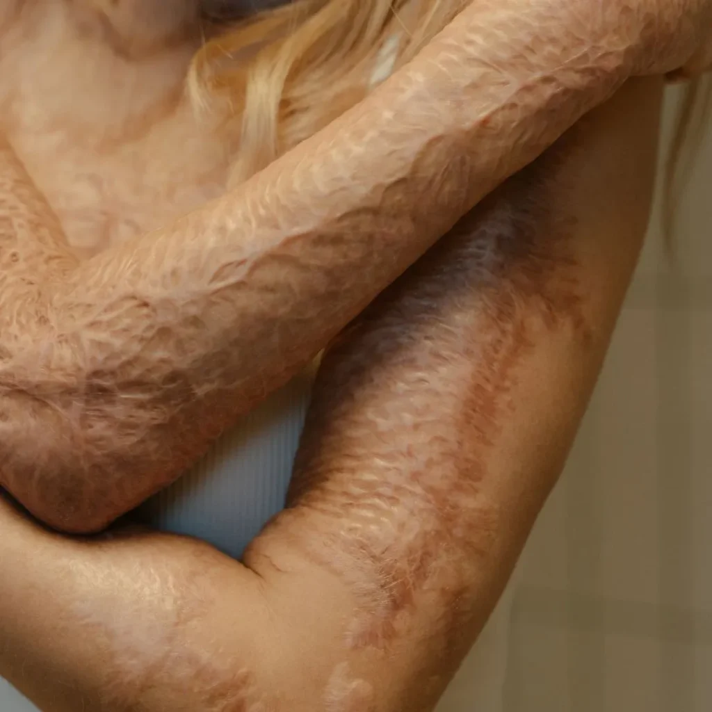 Burn surgery 1 burn surgery in Dubai