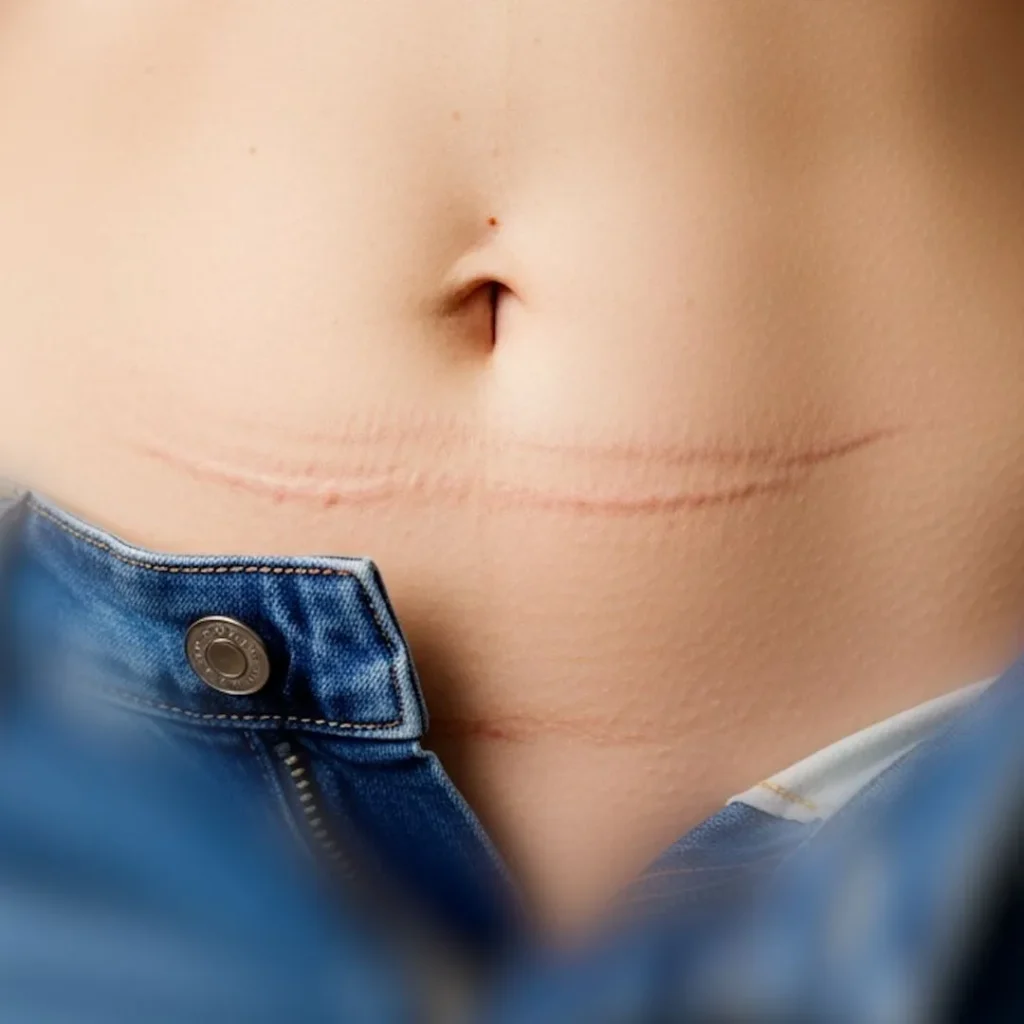 Liposuction 1 liposuction in Dubai