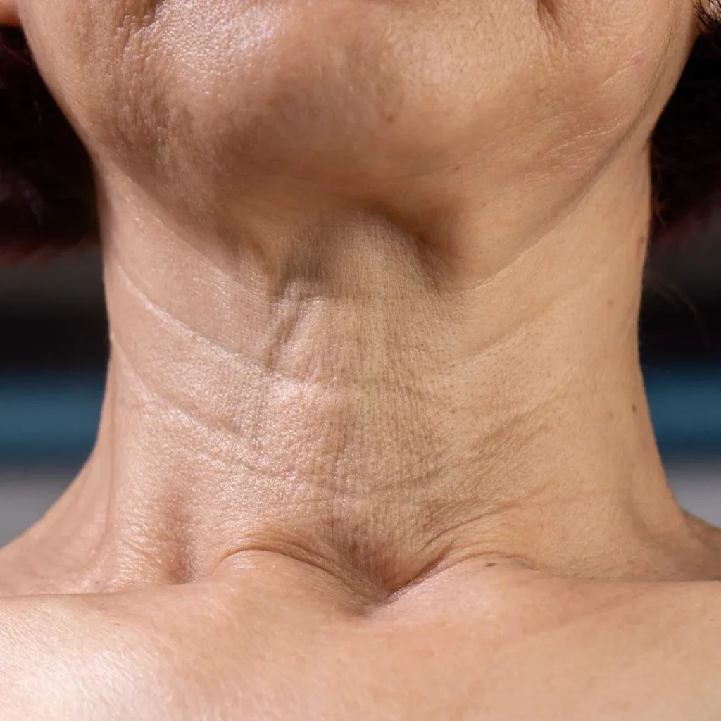 neck lift in Dubai