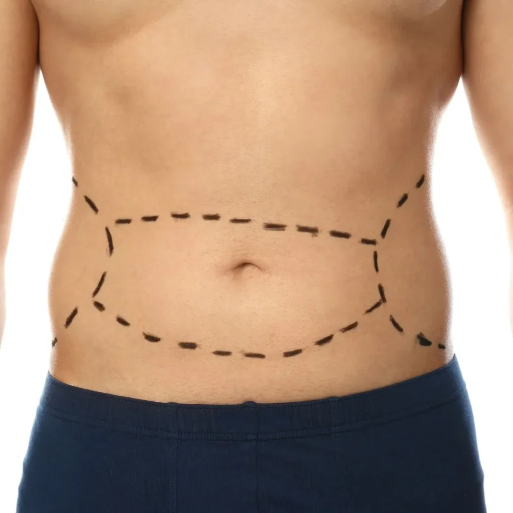 Tummy tuck 1 tummy tuck in Dubai